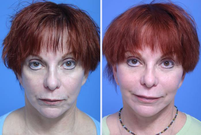 Before and After Image: facial reshaping – case 4 - other