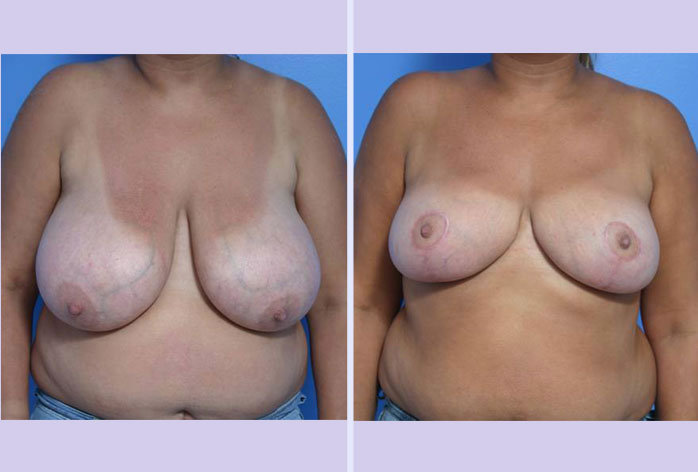 Before and After Image: breast reduction – case 2 - front