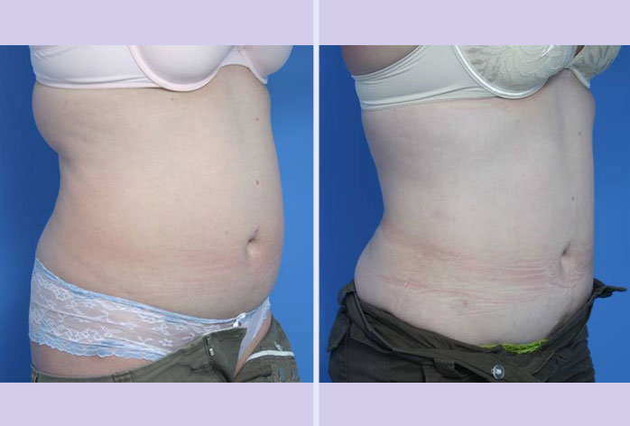 Before and After Image: liposuction – case 11 - right-front-oblique