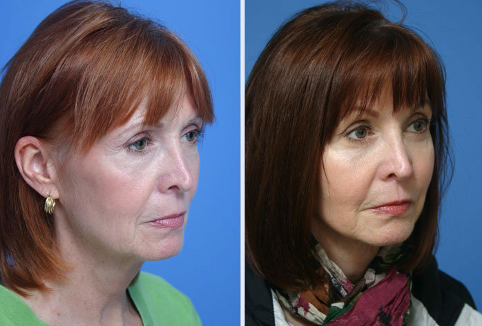 Before and After Image: 3-d volumetric facelift – case 5 - right-front-oblique