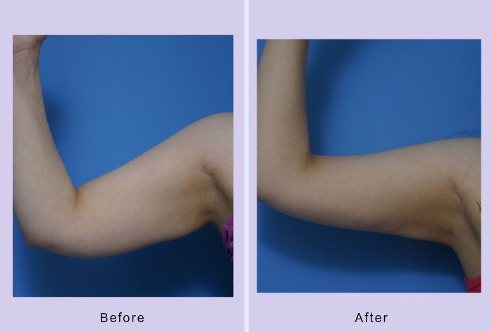 Before and After Image: liposuction – case 15 - right-side