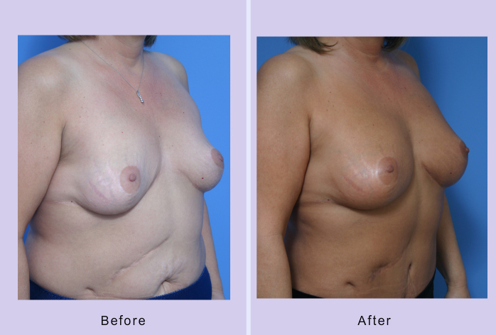 Before and After Image: breast correction – case 8 - right-front-oblique