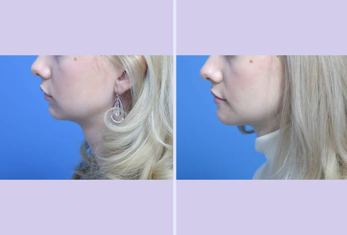 Before and After Image: chin augmentation – case 3 - left-side