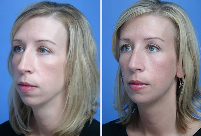 Before and After Image: rhinoplasty – case 4 - left-front-oblique