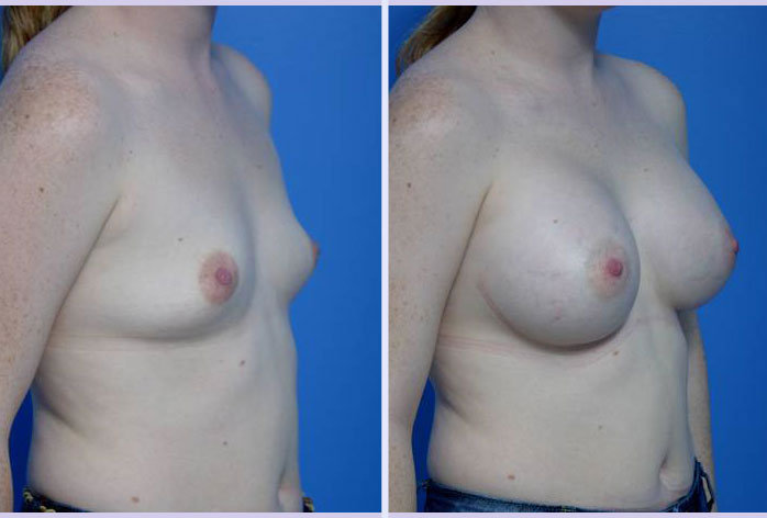 Before and After Image: breast augmentation – Case 3 - right-front-oblique