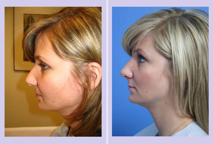 Before and After Image: rhinoplasty – case 1 - left-side