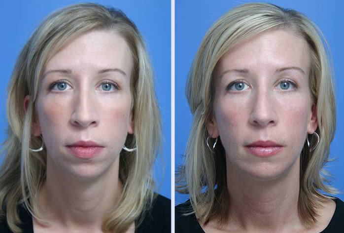 Before and After Image: chin augmentation – case 2 - front