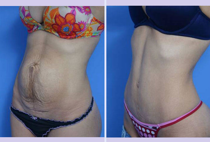 Before and After Image: abdominoplasty – tummy tuck – Case 17 - left-front-oblique