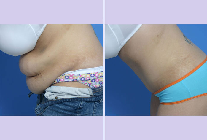 Before and After Image: abdominoplasty – tummy tuck – Case 12 - other