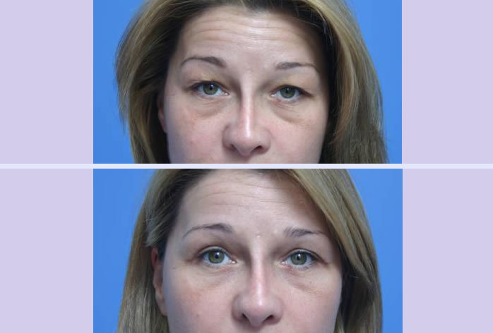 Before and After Image: blepharoplasty – case 7 - other