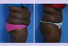 Before and After Image: abdominoplasty – tummy tuck – Case 21 - right-side