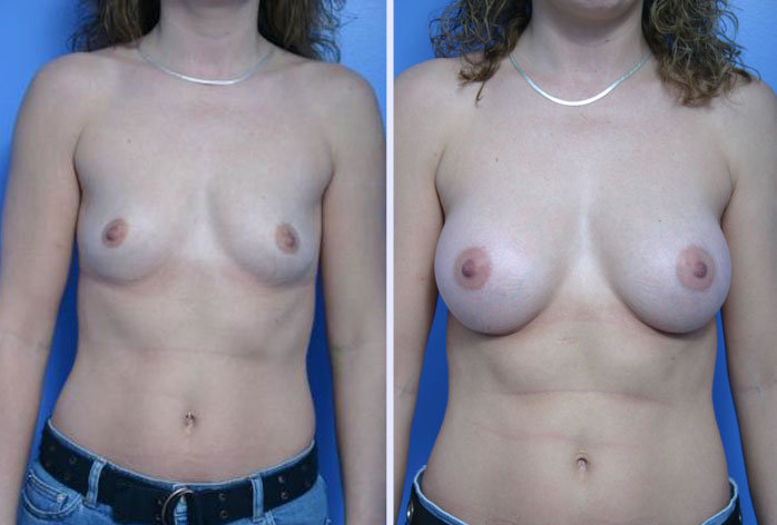 Before and After Image: breast augmentation – Case 9 - front