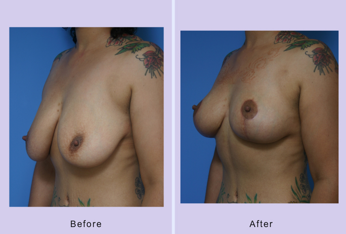Before and After Image: breast lift – case 7 - left-front-oblique