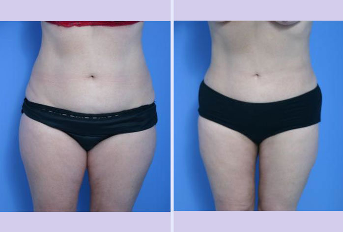 Before and After Image: liposuction – case 7 - front