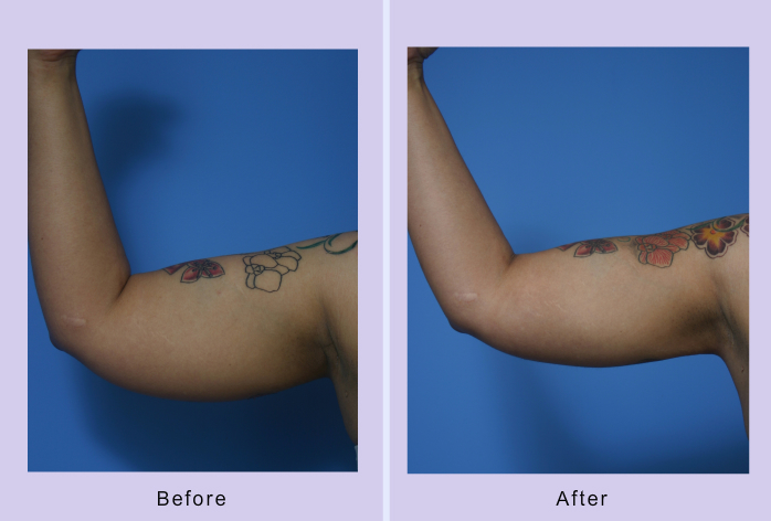 Before and After Image: liposuction – case 14 - left-side