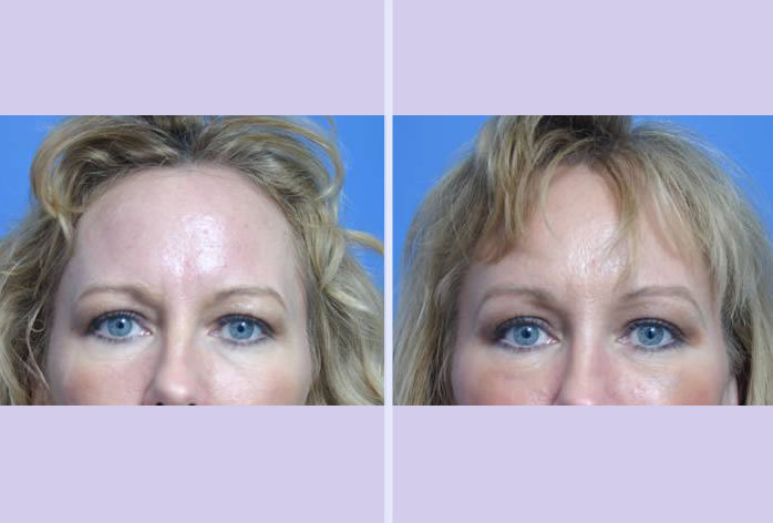 Before and After Image: browlift – case 2 - front