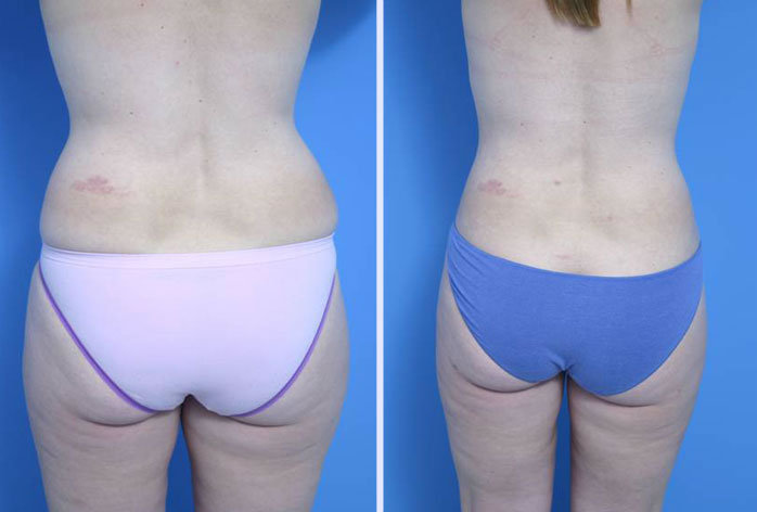 Before and After Image: liposuction – case 10 - back