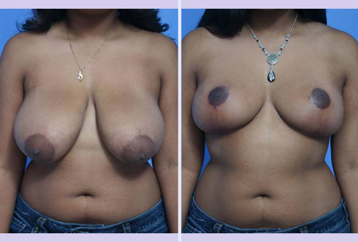 Before and After Image: breast reduction – case 4 - front