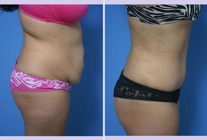 Before and After Image: abdominoplasty – tummy tuck – Case 11 - right-side