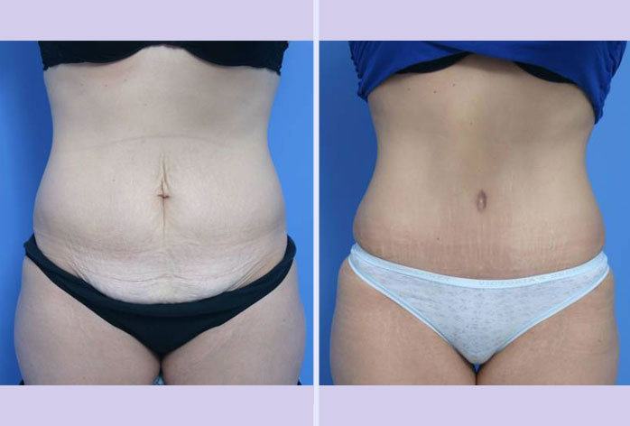 Before and After Image: abdominoplasty – tummy tuck – Case 10 - front