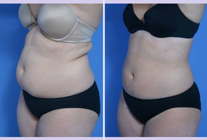Before and After Image: liposuction – case 2 - left-front-oblique