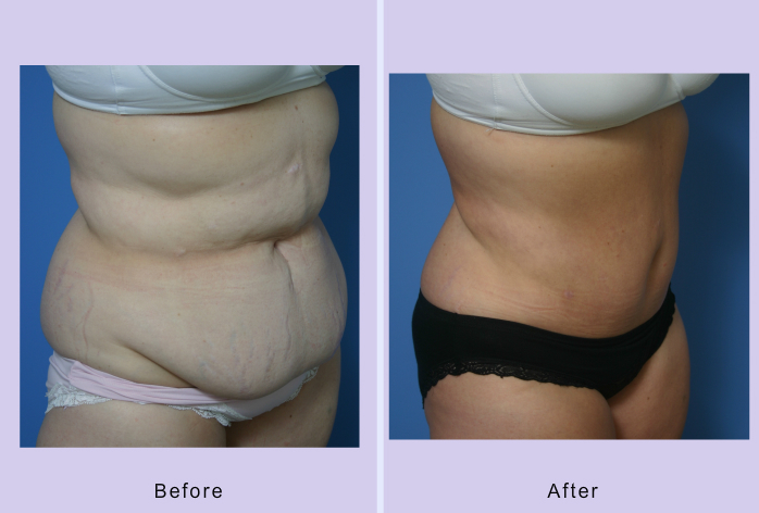 Before and After Image: abdominoplasty – tummy tuck – Case 3 - right-front-oblique