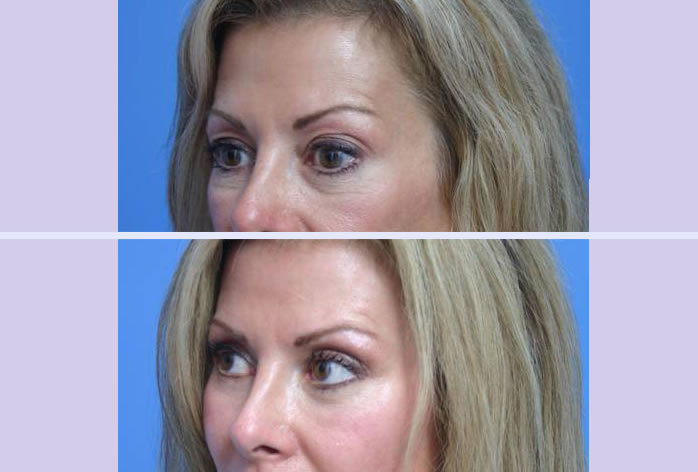 Before and After Image: blepharoplasty – case 5 - left-front-oblique