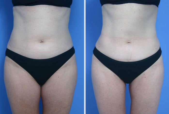 Before and After Image: liposuction – case 13 - front