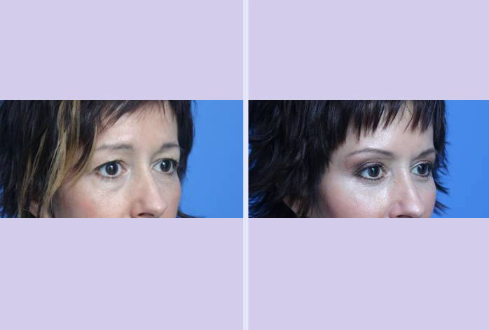 Before and After Image: blepharoplasty – case 1 - right-front-oblique