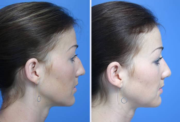 Before and After Image: rhinoplasty – case 2 - right-side