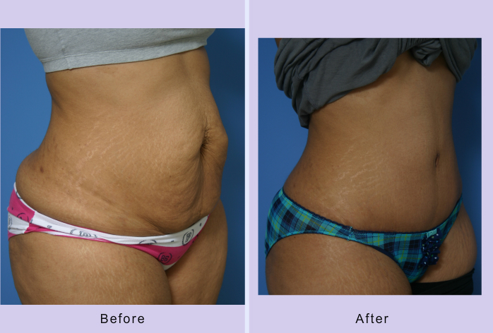 Before and After Image: abdominoplasty – tummy tuck – Case 19 - right-front-oblique