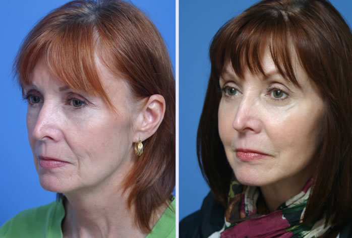 Before and After Image: 3-d volumetric facelift – case 5 - left-front-oblique
