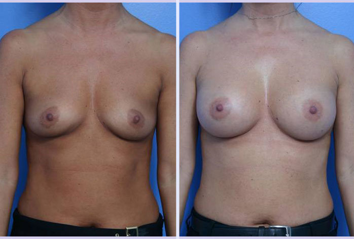Before and After Image: breast augmentation – Case 4 - front