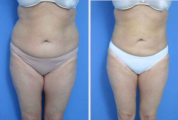 Before and After Image: liposuction – case 4 - front