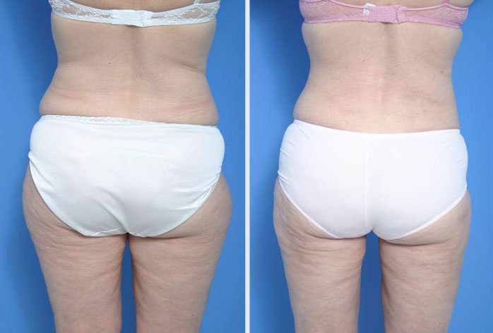 Before and After Image: liposuction – case 6 - back