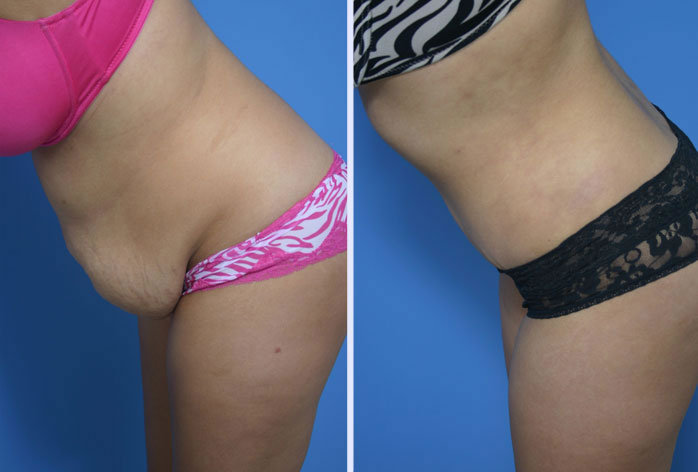 Before and After Image: abdominoplasty – tummy tuck – Case 11 - other