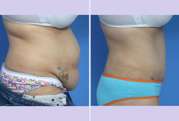 Before and After Image: abdominoplasty – tummy tuck – Case 12 - right-side