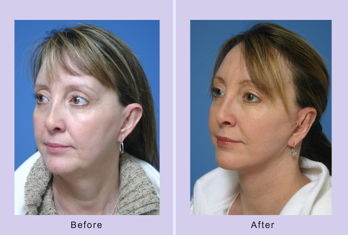 Before and After Image: facelift and mini facelift – case 9 - left-front-oblique