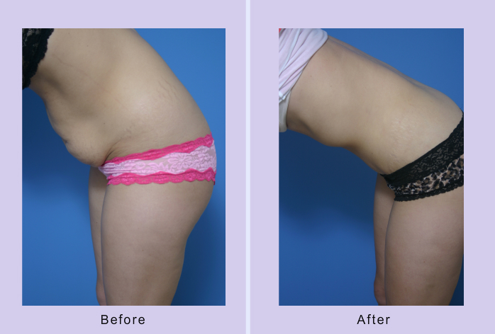 Before and After Image: abdominoplasty – tummy tuck – Case 18 - other