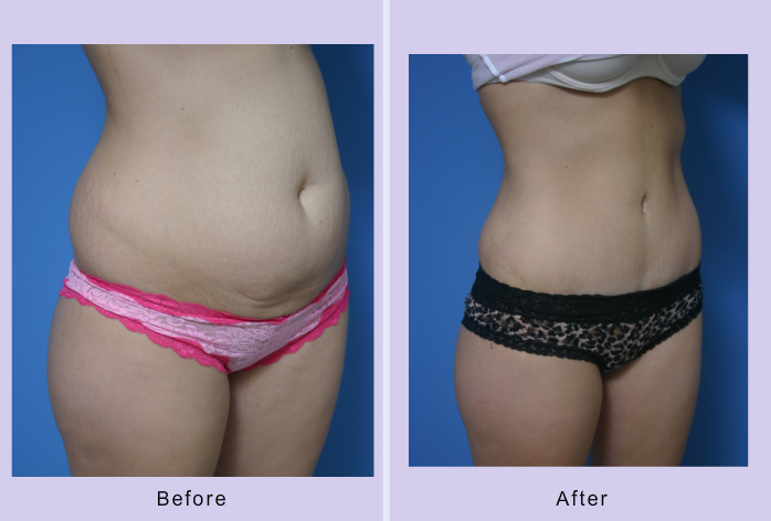 Before and After Image: abdominoplasty – tummy tuck – Case 18 - right-front-oblique