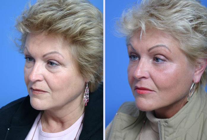 Before and After Image: 3-d volumetric facelift – case 10 - left-front-oblique