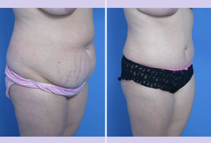 Before and After Image: abdominoplasty – tummy tuck – Case 20 - right-front-oblique
