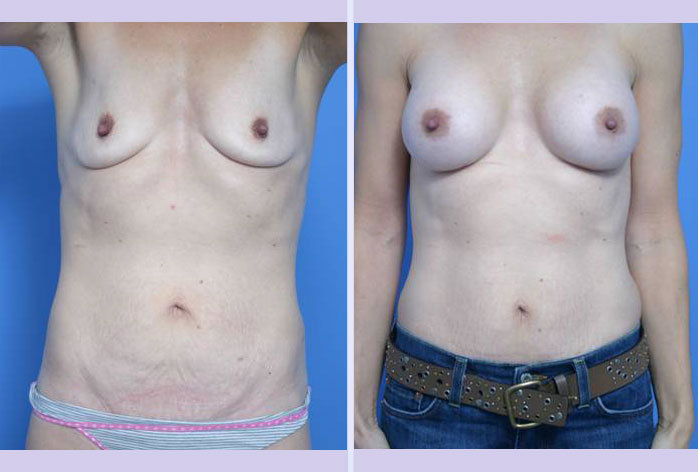 Before and After Image: mommy makeover – case 1 - front