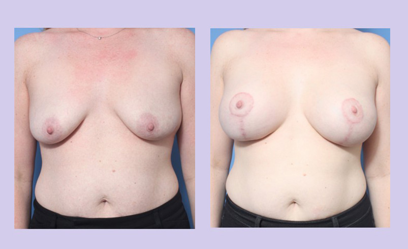 Before and After Image: Breast Lift – Case 20 - front