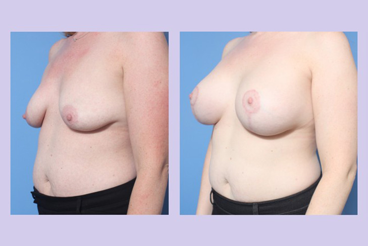Before and After Image: Breast Lift – Case 20 - left-front-oblique