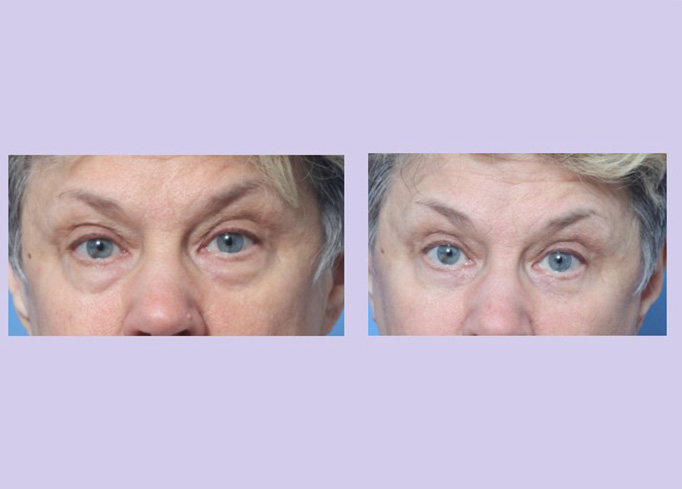 Before and After Image: Lower Blepharoplasty – Case 35 - front