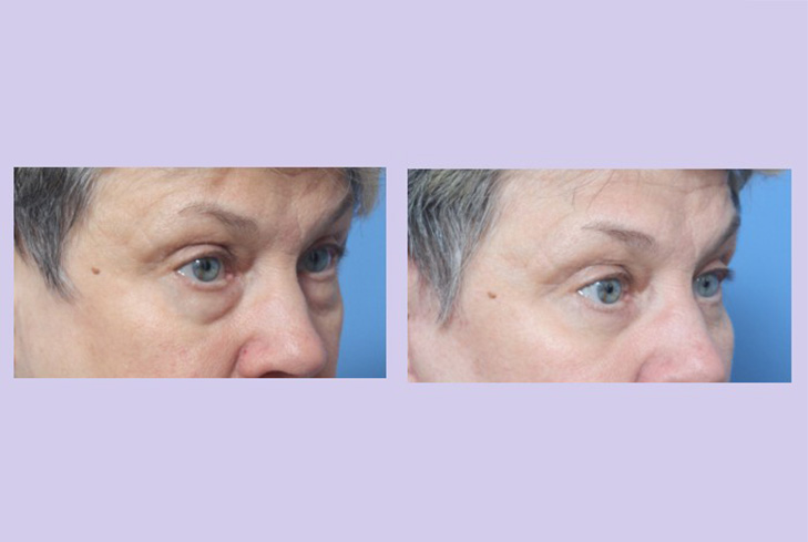 Before and After Image: Lower Blepharoplasty – Case 35 - right-front-oblique