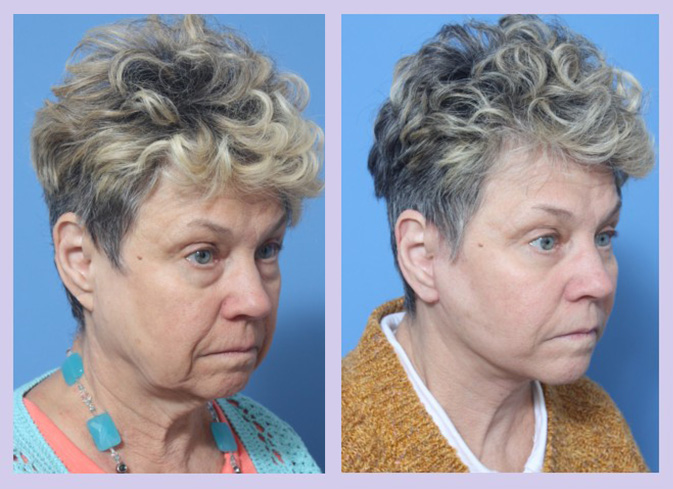 Before and After Image: Lower Facelift – Case 21 - right-front-oblique