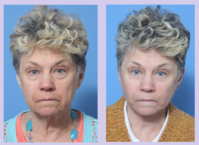 Before and After Image: Lower Facelift – Case 21 - front