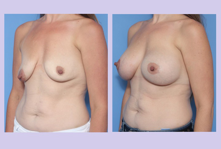 Before and After Image: Breast Correction  – Case 21 - other